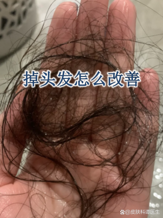 夏季容易掉头发，四招帮你预防脱发