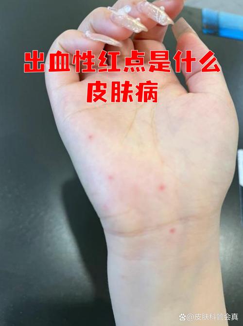 皮肤血液渴求症 第1张 皮肤血液渴求症 第1张